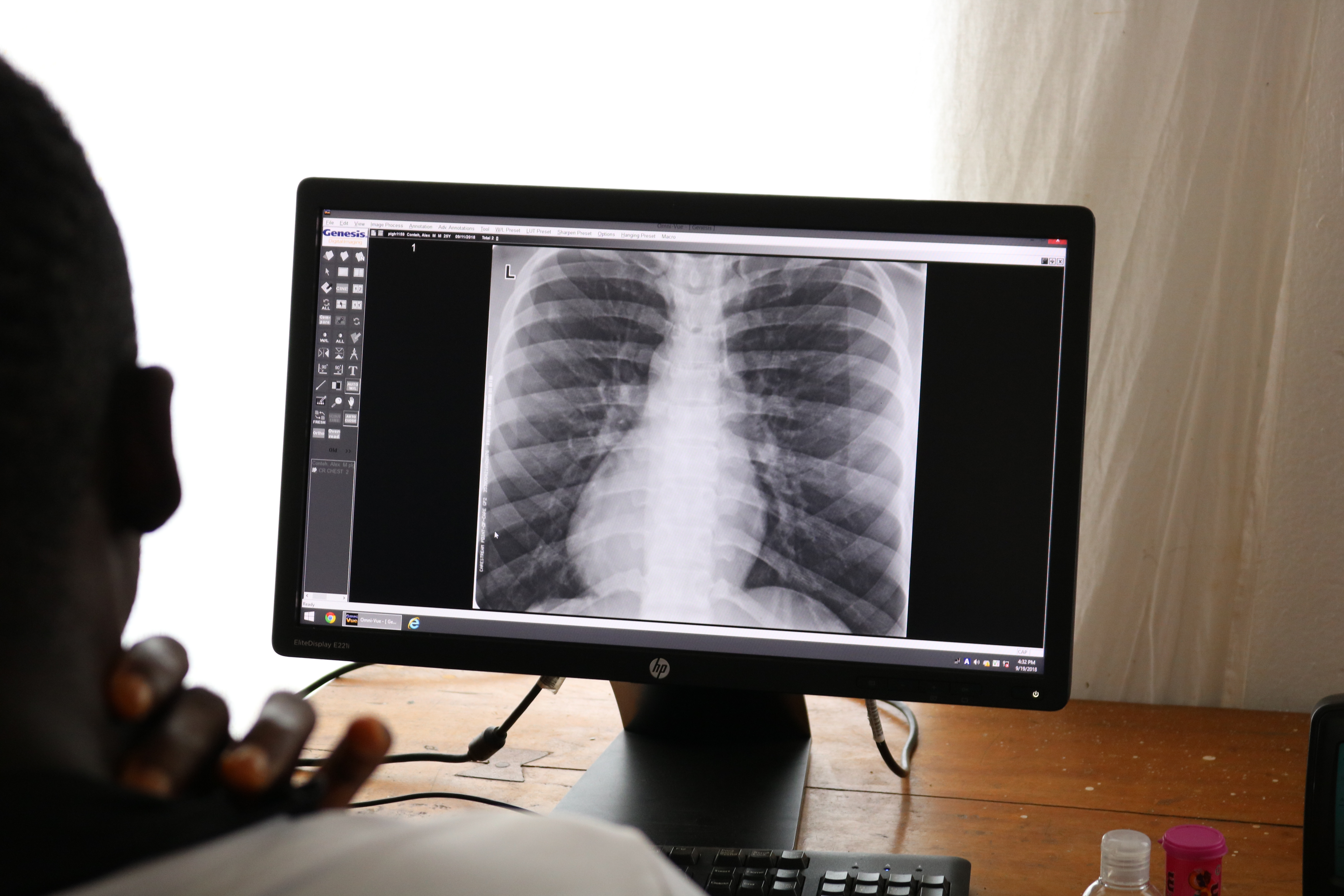 Radiographie poumons