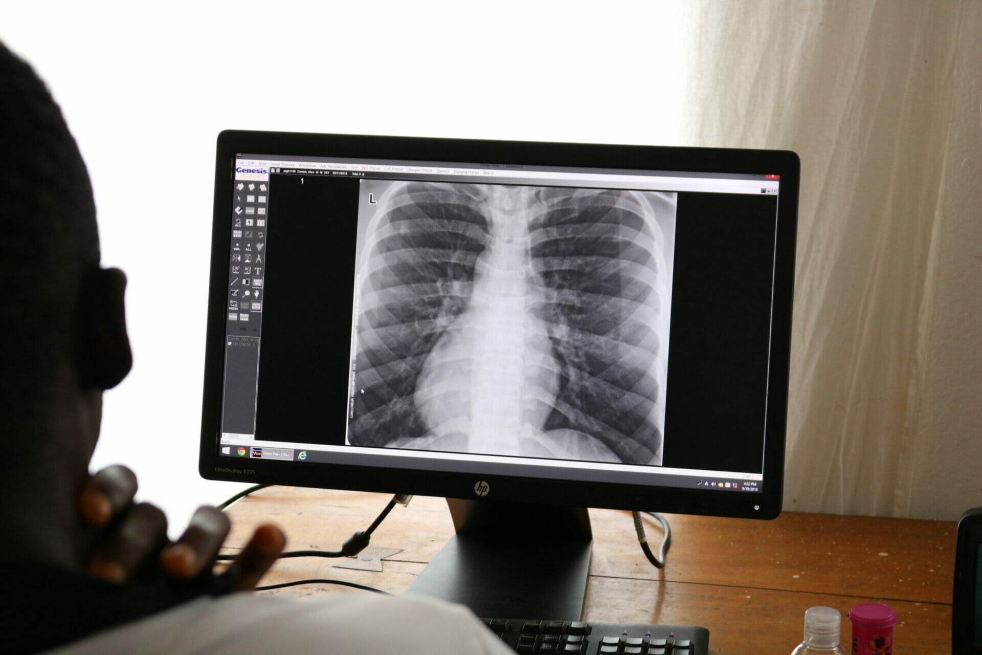 Les résultats de TB-Speed Pneumonia présentés à la conférence de l’Union